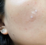 FOCALLURE - Acne Pimple Patch-Day & Night - Image 7